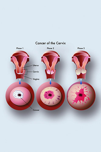 宫颈癌医学人体器官组织解剖插图元素