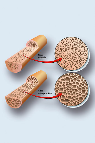 骨质疏松医学人体器官组织解剖插图元素