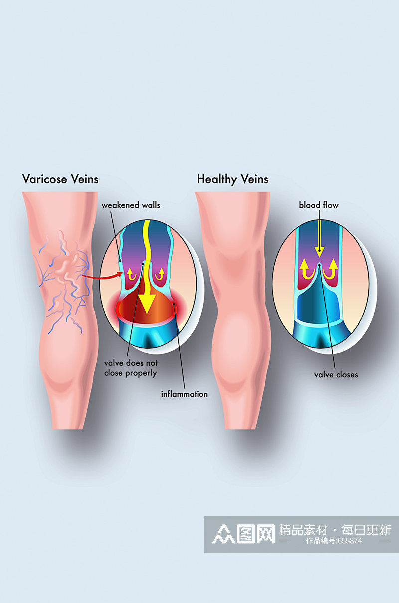 静脉曲张医学人体器官组织解剖插图元素素材