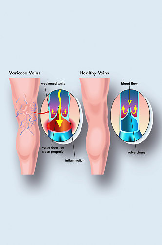 静脉曲张医学人体器官组织解剖插图元素