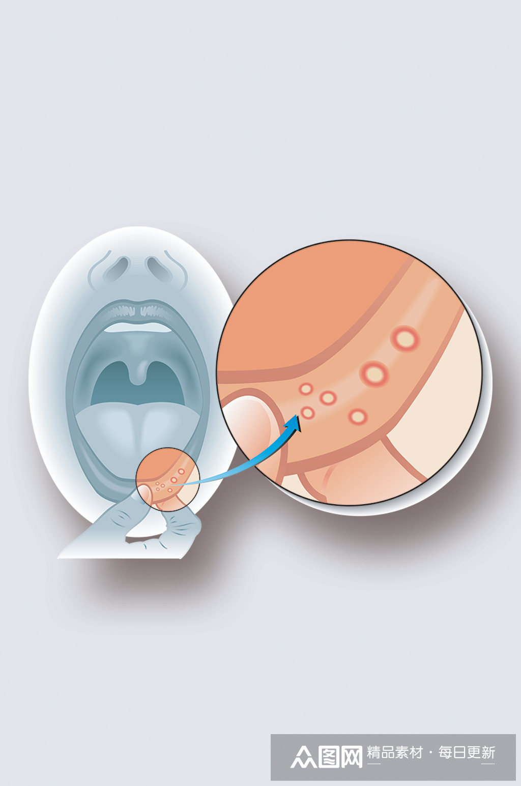 嘴唇感染病症解析图医学器官解剖插图
