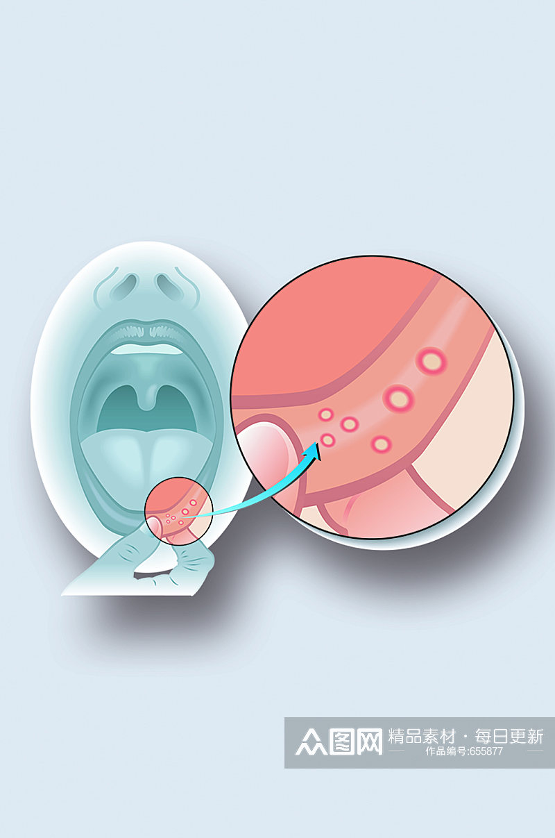 嘴唇感染病症解析图医学器官解剖插图素材