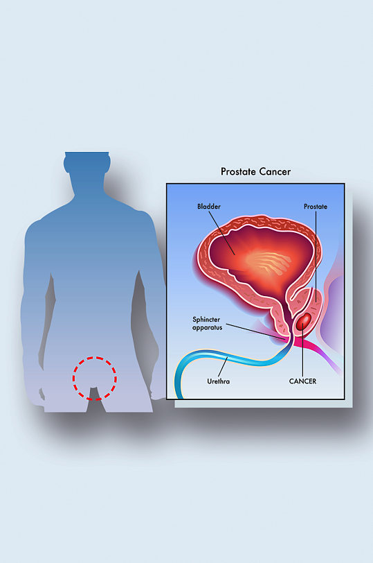 人体前列腺癌病症解析图医学器官解剖插图