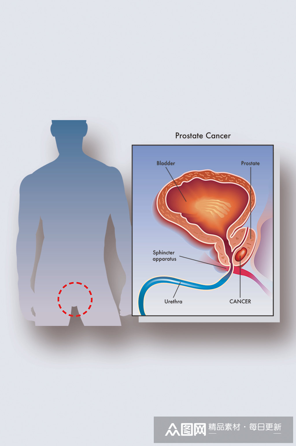 人体前列腺癌病症解析图医学器官解剖插图