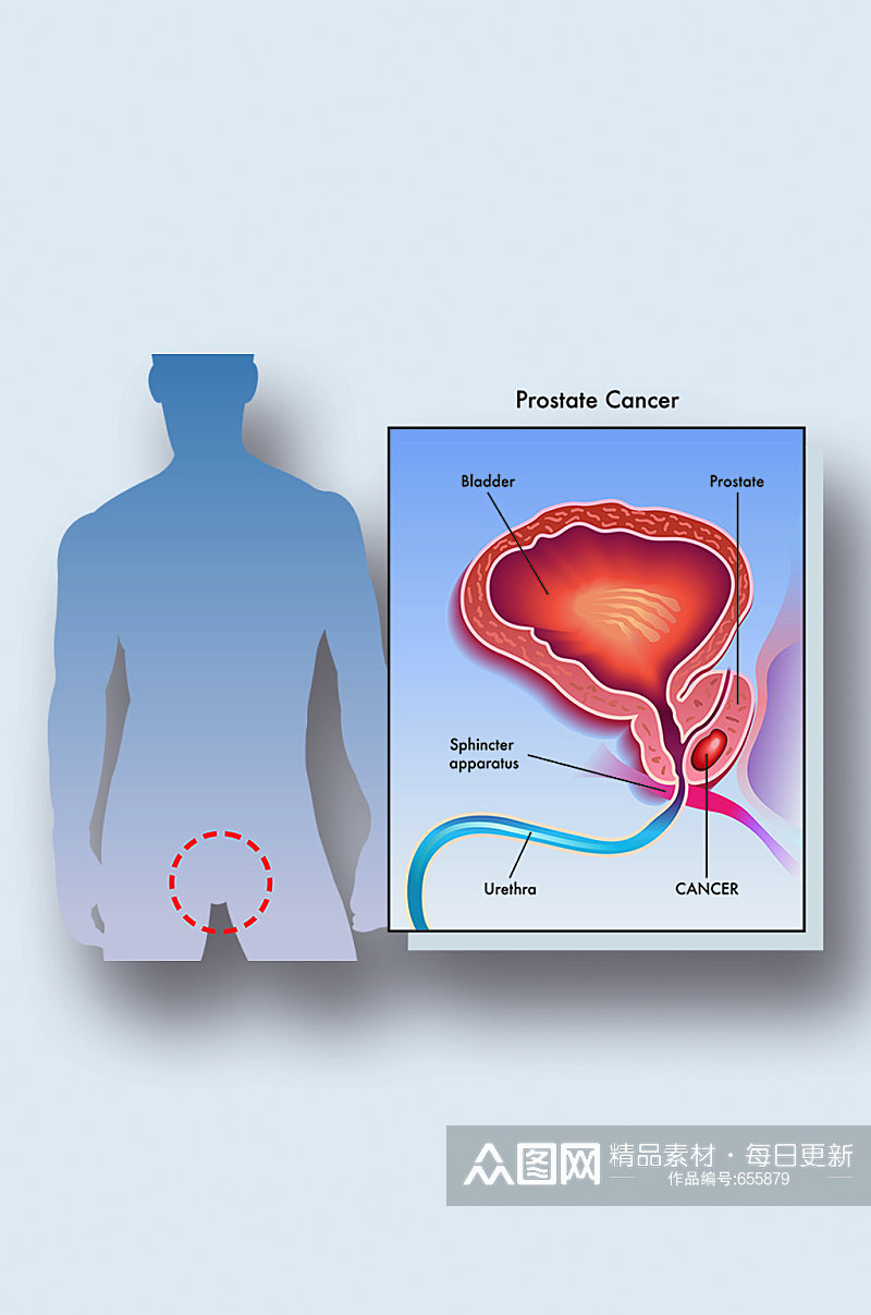 人体前列腺癌病症解析图医学器官解剖插图素材