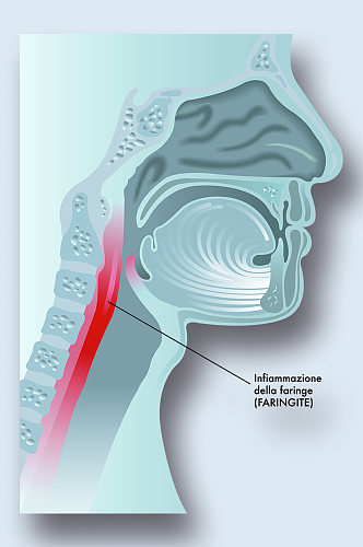 咽部发炎病症解析图医学器官解剖插图