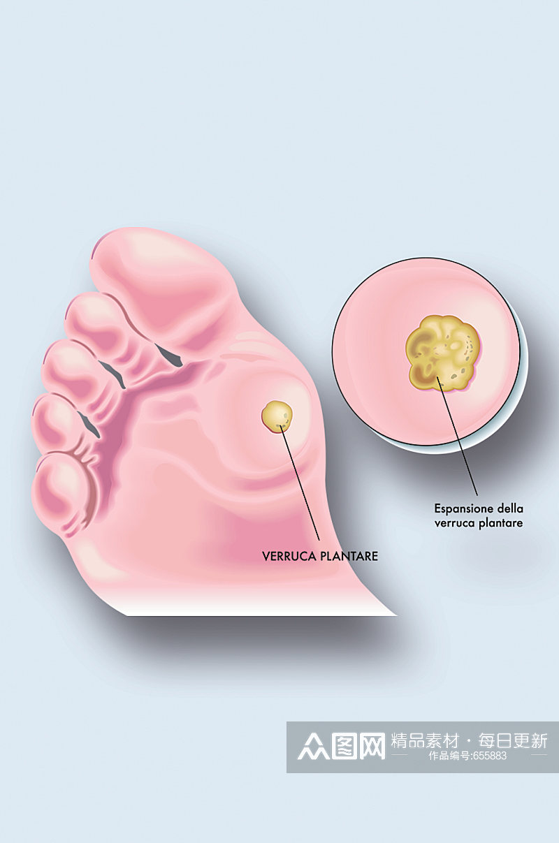 脚廯病症解析图医学器官解剖插图素材