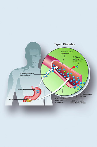 类糖尿病病症解析图医学器官解剖插图
