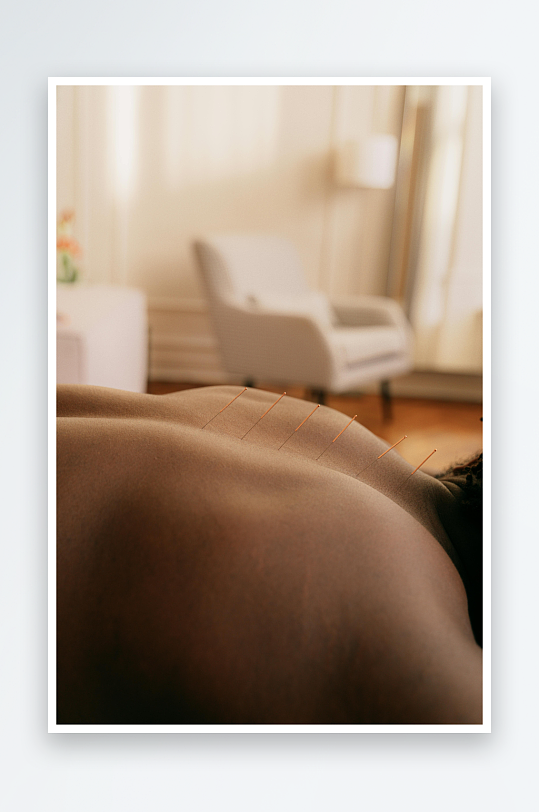 背部针灸治疗场景-众图网