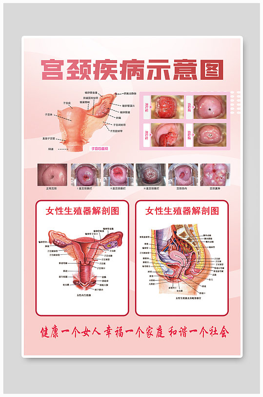 宫颈疾病示意图海报