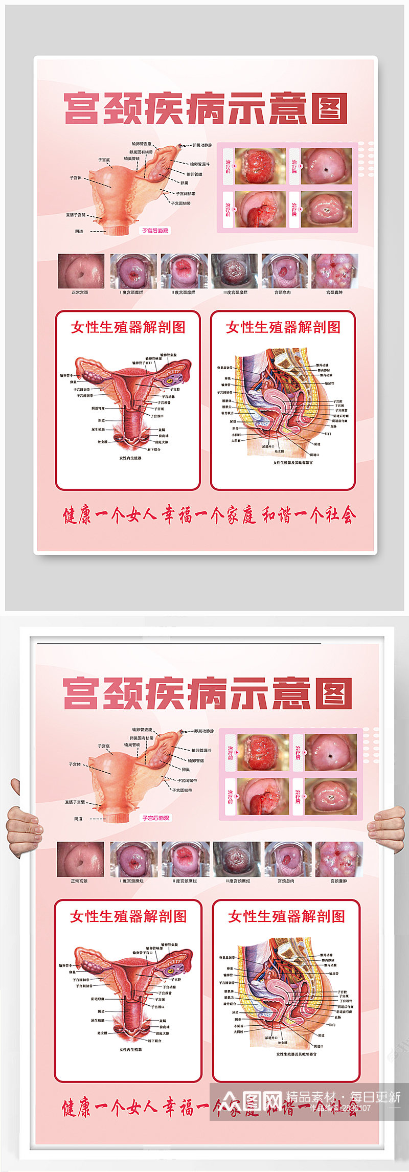 宫颈疾病示意图海报素材