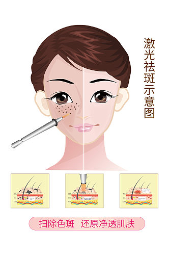 手绘激光祛斑示意图