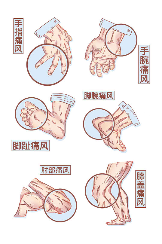 卡通可爱手绘痛风示意图