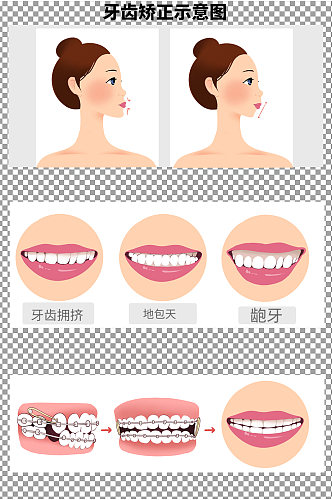 矫正牙齿示意图图片