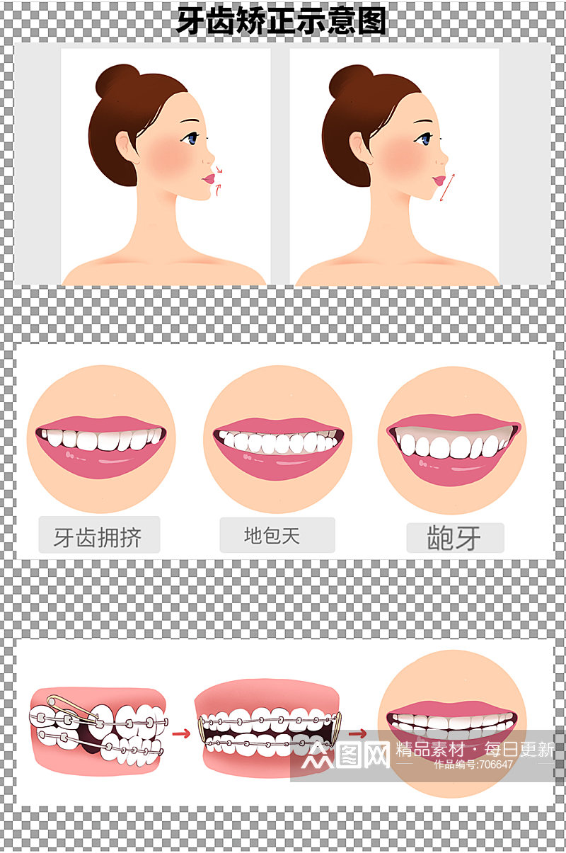 矫正牙齿示意图图片素材