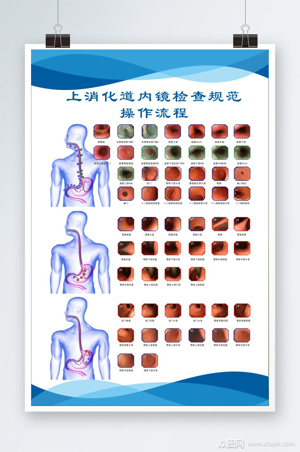 上消化道内镜检查规范操作流程素材