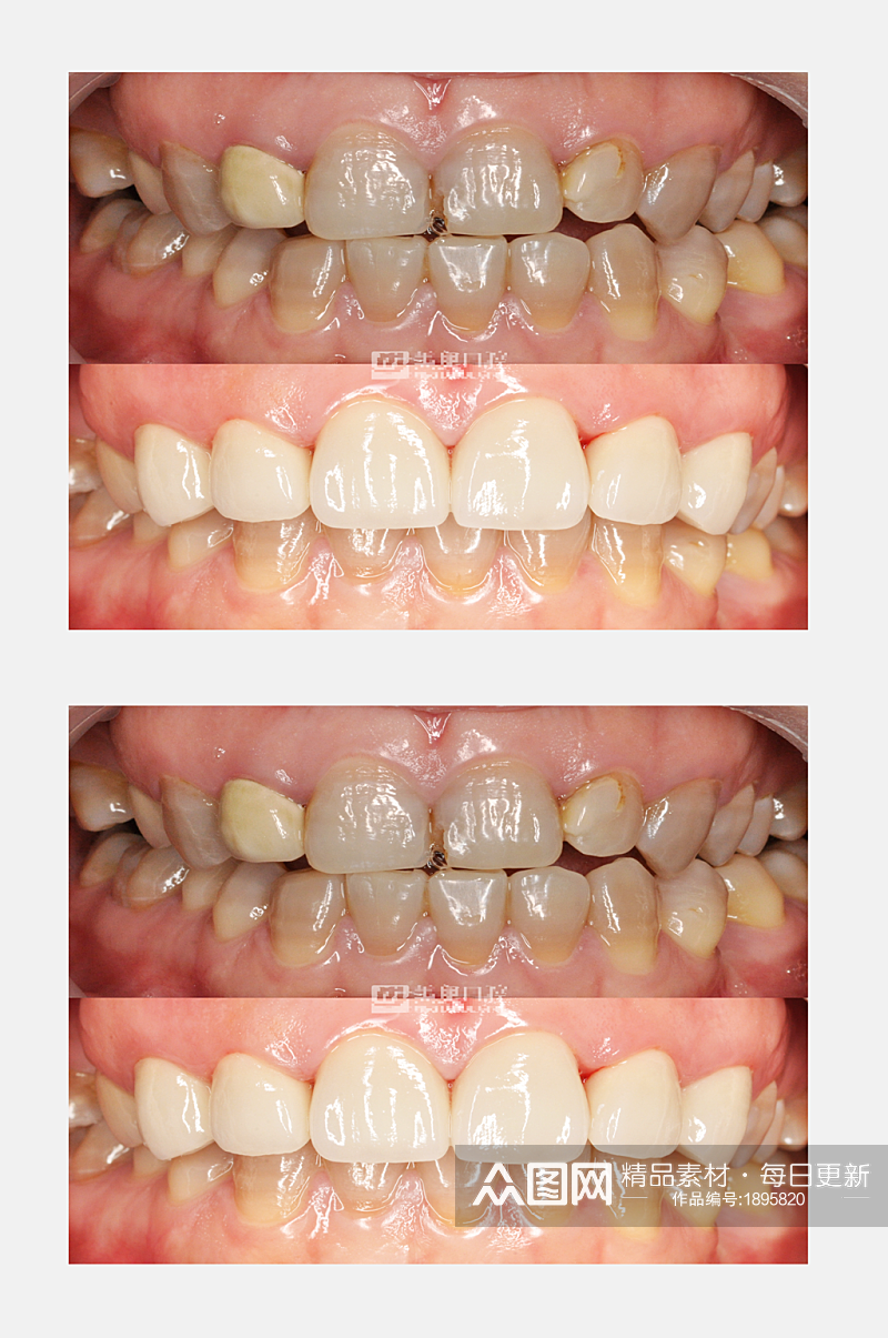 色素牙口腔牙齿对比素材