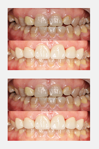 色素牙口腔牙齿对比