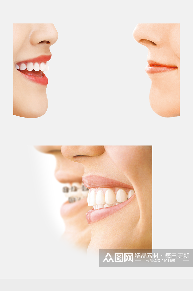 口腔牙齿矫正微笑图片PSD设计素材素材