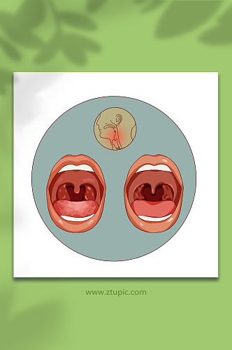 喉咙扁桃体慢性病咽炎疾病医疗插画